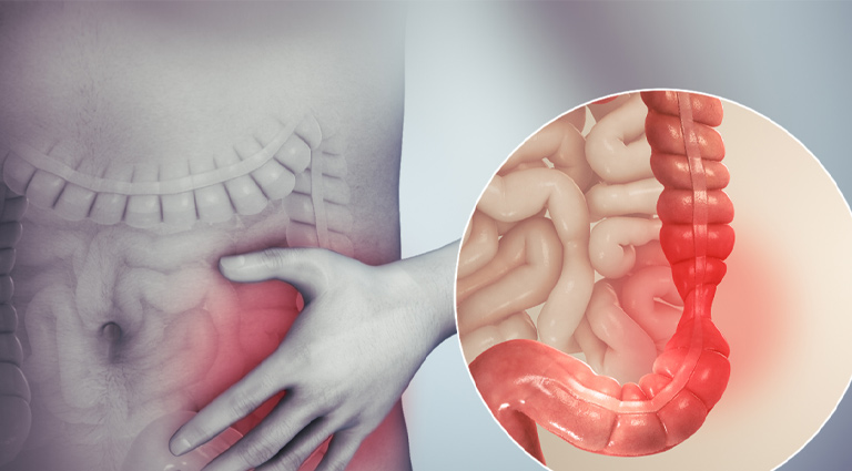 Hội chứng ruột kích thích có thể là nguyên nhân gây đau dạ dày