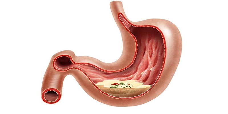 biến chứng tiềm ẩn của đau dạ dày